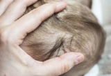 Seborrheic Dermatitis in Babies: 10 Ways To Treat Cradle Cap